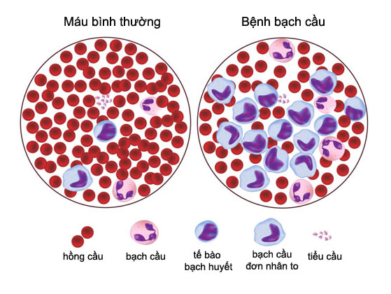 Bạch cầu Lympho mạn tính (CLL) - Hình ảnh minh họa